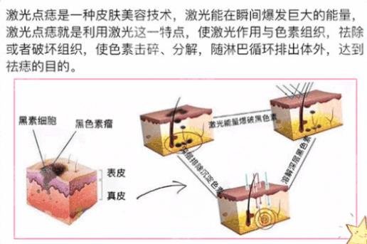 点点痣完多久可以洗脸_点点痣后多久可以洗脸_点痣什么点