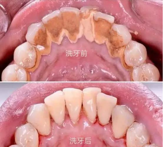 牙齿太黄洗牙能洗掉吗_牙齿能洗掉洗牙黄渍吗_洗牙齿能不能洗掉黄牙齿