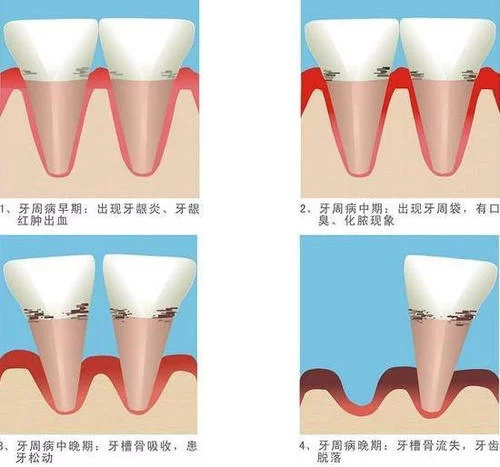 牙齿能洗掉洗牙黄渍吗_洗牙齿能不能洗掉黄牙齿_牙齿太黄洗牙能洗掉吗