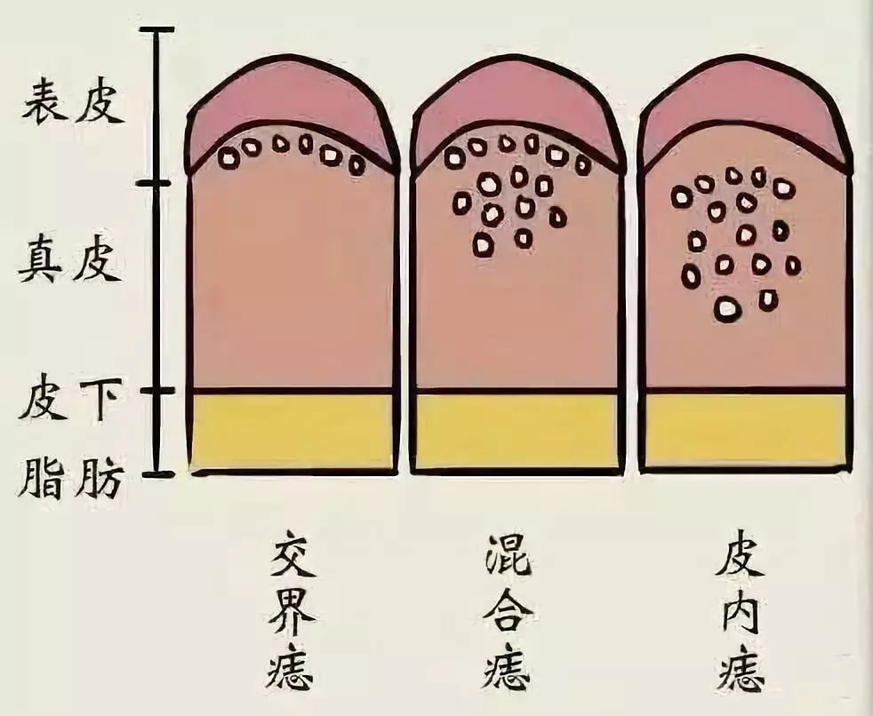 点点痣有什么危害_点痣哪里点_点点痣后要忌口吗