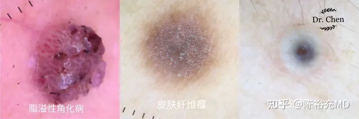 点痣笔点痣安全吗_点痣的点痣_点痣了